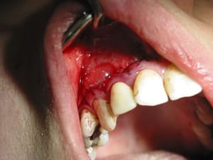 Sutures et bulles. - Eugenol