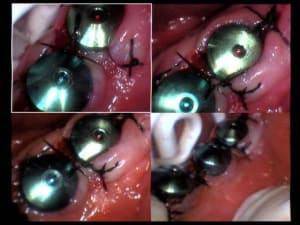 Sutures terminées hdjkqw - Eugenol