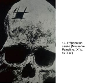 Trépanation umedum - Eugenol