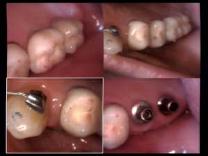 Un cas difficile essai bridge sur implants haut droit 2 jhyf6m - Eugenol