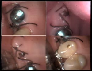 Un cas difficile implant 17 à huit jours am7hdi - Eugenol