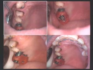 Un cas difficile implants 16 et 17 empreinte chyem6 - Eugenol