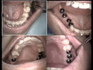 Un cas difficile ortho en cours après réouverture 1 yuex5e - Eugenol