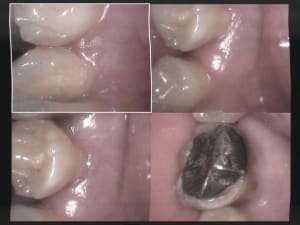 Un cas difficile paro à 20 jours 1 ulpxbr - Eugenol