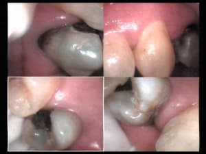 Un cas difficile paro à 90 jours 8 pyrpv3 - Eugenol
