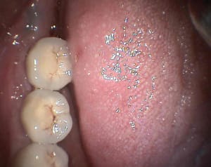 Vestibulaire sk0lsv - Eugenol
