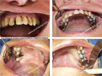 001 guide chirurgical dentaire positdental enhlck - Eugenol
