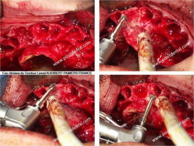 003 guide chirurgical dentaire positdental xxuowm - Eugenol
