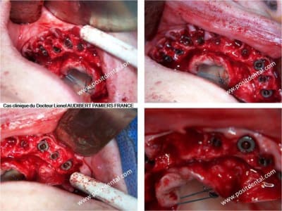 007 guide chirurgical dentaire positdental shse2v - Eugenol