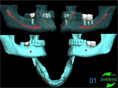 01 positdental guide chirurgical juxta muqueux   appuis dentaires zfomui - Eugenol