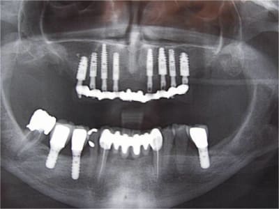 012 guide chirurgical dentaire positdental crdoaf - Eugenol