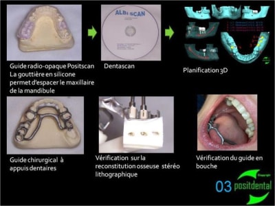 03 positdental guide chirurgical juxta muqueux   appuis dentaires uluim5 - Eugenol