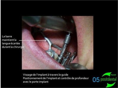 05 positdental guide chirurgical juxta muqueux   appuis dentaires jmejnm - Eugenol