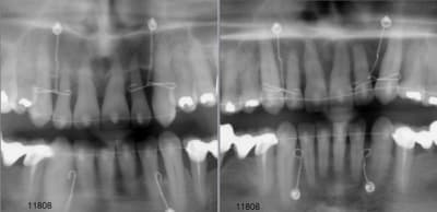 11808 ct0 avant apr s defazn - Eugenol