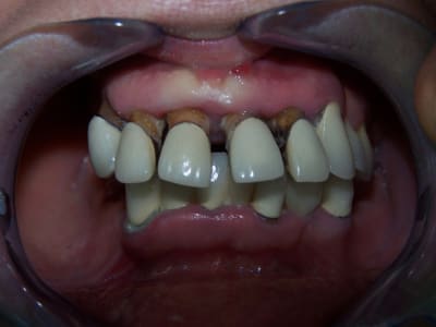 11 03 23 positdental 037 zgxv5y - Eugenol