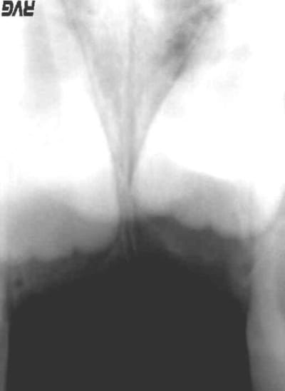 1 mois apres z74b6r - Eugenol