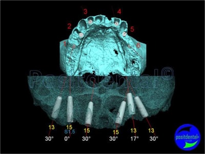 1 planification implantaire   mise en charge imm diate post extractionnelle   mcipe 004 mzwoh3 - Eugenol