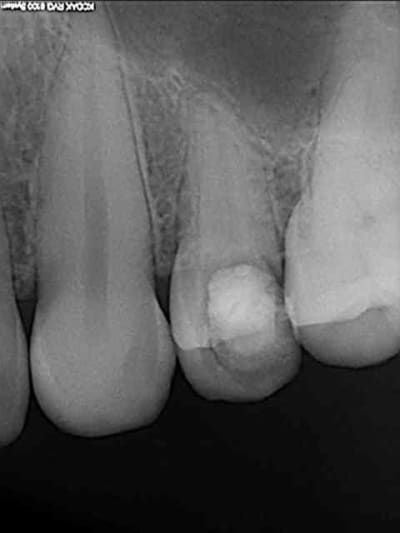 1 dent d labr e wicnaw - Eugenol