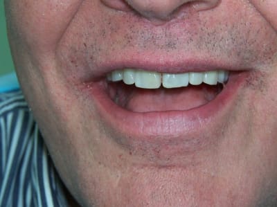 2013 03 13 positdental 068 irk0iw - Eugenol