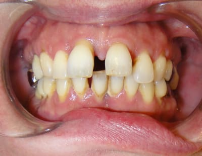 2013 dents avant extraction g3z1rt - Eugenol