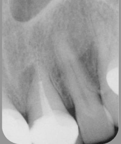 21 preop jzjhne - Eugenol