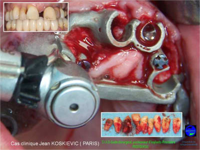 22 extraction mci bridge provisoire avec armature m tal b3f6ir - Eugenol