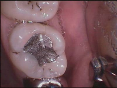 26 avant traitement vxfue0 - Eugenol