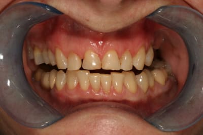 2   dents avant nqguzj - Eugenol
