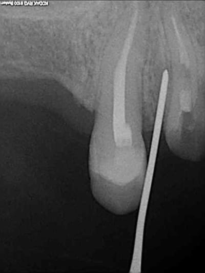 2 periotome ksagph - Eugenol