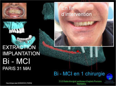 31 mai  mci buzglr - Eugenol