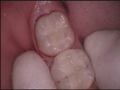 36 37 inlays cerec c66vjm - Eugenol