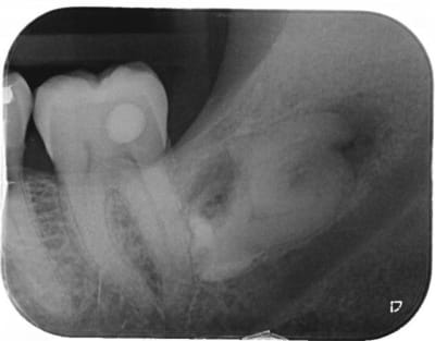 38 cariee 1 waudr9 - Eugenol