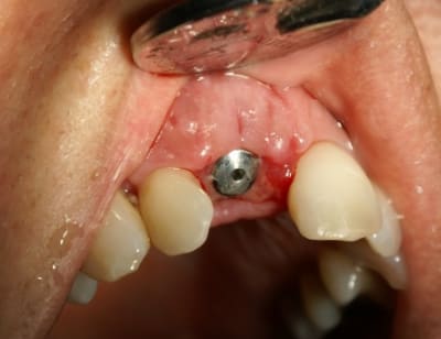 6 dix jours plus tard pul9xs - Eugenol