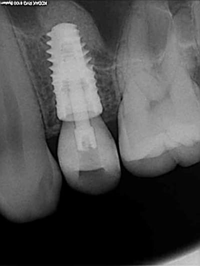 7 implant et provisoire en place ac0ywg - Eugenol