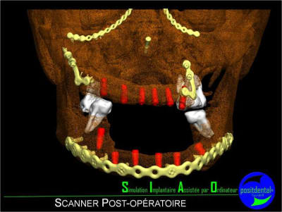 Aa simulation implantaire assist e par ordinateur 017 uathss - Eugenol