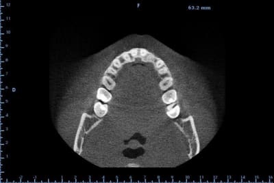 Axial pjlgco - Eugenol