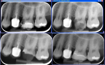 Biodentineremontedemargeonlay ykgexl - Eugenol