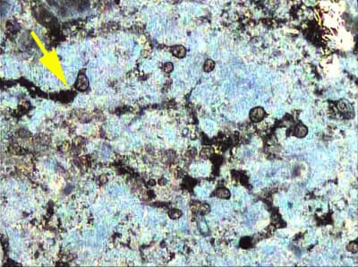 Biofilm parasitaire 100x dans la parodontite chronique ou agressivefl che blpymp - Eugenol