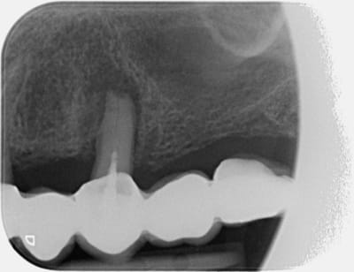 Bridge bulgare efels0 - Eugenol