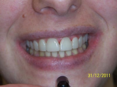 Cas n 3 apres oe6crf - Eugenol