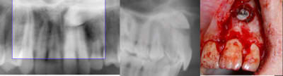 Canine incluse vestibulaire torsul - Eugenol