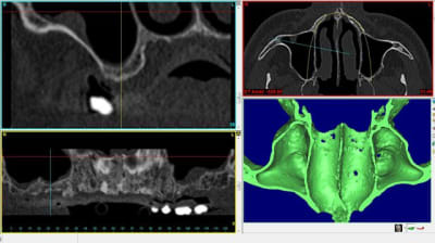 Capture avant sinus lift droit sagey5 - Eugenol