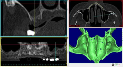 Capture avant sinus lift gauche nhp6i8 - Eugenol