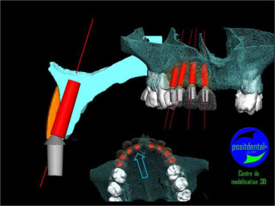 Comment simplifier et fiabiliser les greffes cas clinique dr pxav 6 mpweb8 - Eugenol