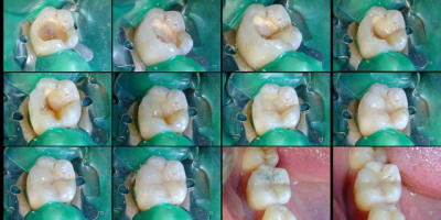 Compo - Eugenol