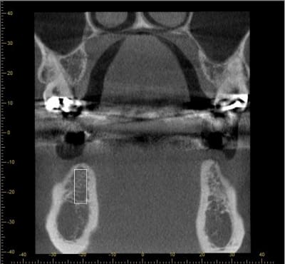 Coupe 4 implant 46 lzse9d - Eugenol