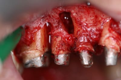 D bridement rgbcd2 - Eugenol