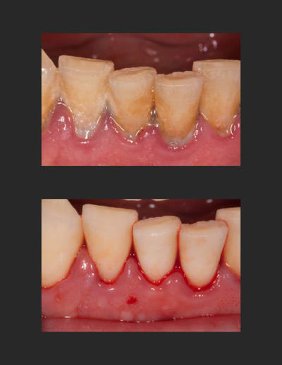 D tartrage fuflg5 - Eugenol