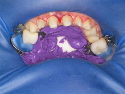 Digue  large  nk2n0d - Eugenol