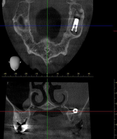 Dr guillaumin mondelange  implant dans sinus rxy6lr - Eugenol